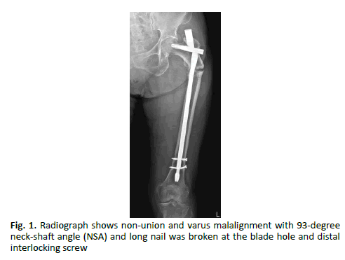 Orthopaedics-Trauma-Surgery-neck-shaft