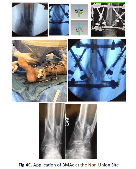 Orthopaedics-Trauma-Surgery-non-Union-Site