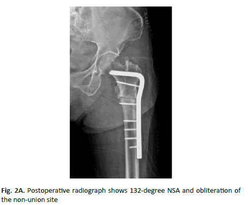 Orthopaedics-Trauma-Surgery-obliteration