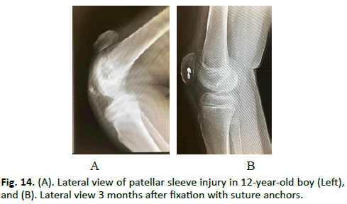 Orthopaedics-Trauma-Surgery-patellar-sleeve-injury
