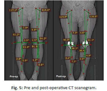 Orthopaedics-Trauma-Surgery-post-operative-CT-scanogram