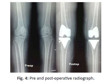 Orthopaedics-Trauma-Surgery-post-operative-radiograph