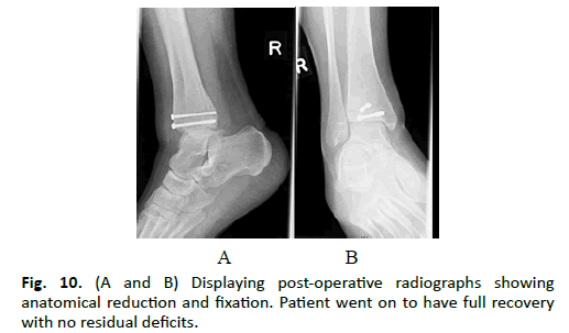 Orthopaedics-Trauma-Surgery-post-operative-radiographs