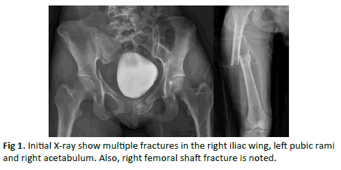 Orthopaedics-Trauma-Surgery-right-femoral-shaft-fracture