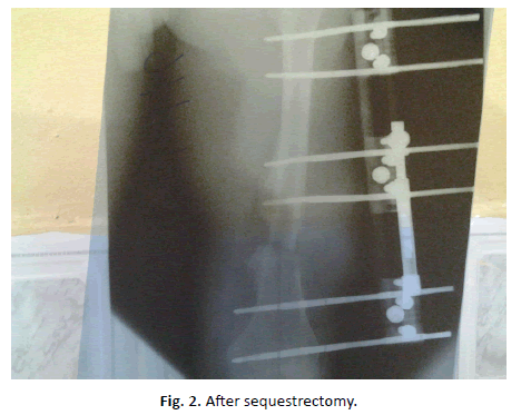 Orthopaedics-Trauma-Surgery-sequestrectomy