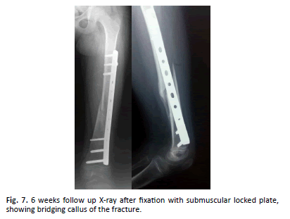 Orthopaedics-Trauma-Surgery-submuscular-locked-plate