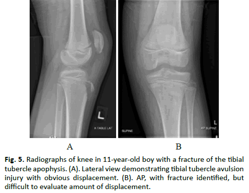 Orthopaedics-Trauma-Surgery-tibial-tubercle-apophysis