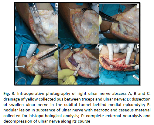 Orthopaedics-Trauma-Surgery-ulnar